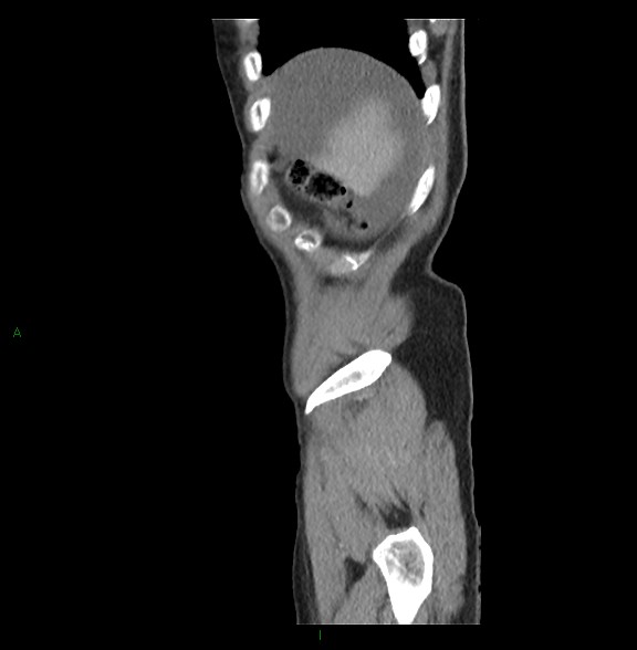 Closed loop small bowel obstruction with ischemia (Radiopaedia 84180-99456 C 8).jpg