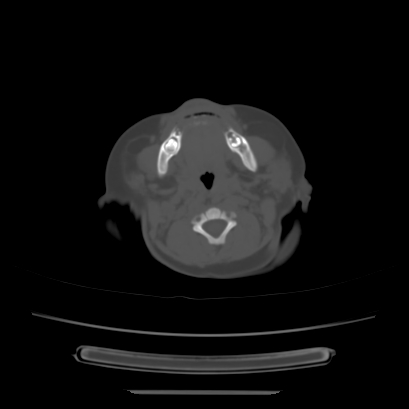 Cloverleaf skull (Radiopaedia 91901-109710 Axial bone window 28).jpg