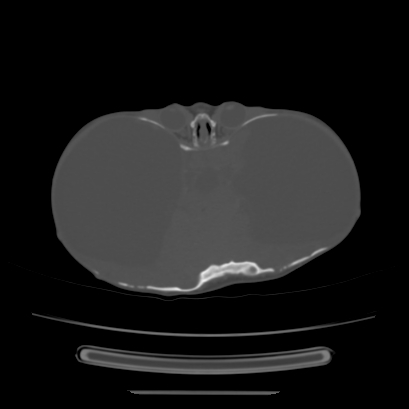 Cloverleaf skull (Radiopaedia 91901-109710 Axial bone window 73).jpg