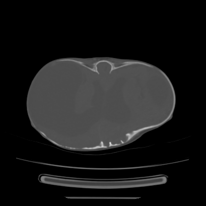 Cloverleaf skull (Radiopaedia 91901-109710 Axial bone window 98).jpg