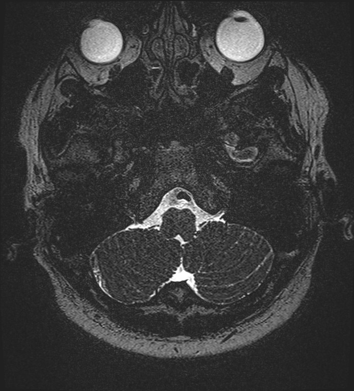 Cochlear incomplete partition type III associated with hypothalamic hamartoma (Radiopaedia 88756-105498 Axial T2 38).jpg