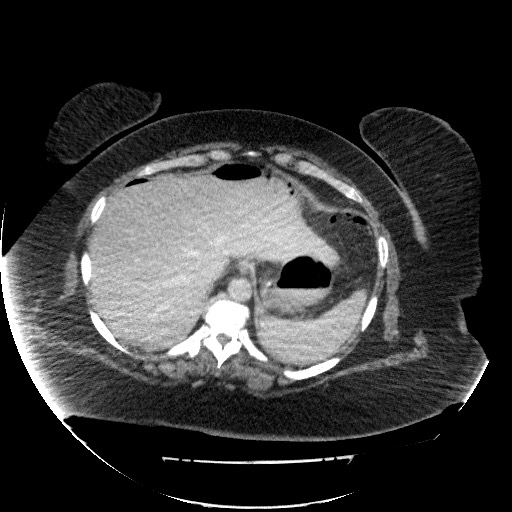 File:Collection due to leak after sleeve gastrectomy (Radiopaedia 55504-61972 A 17).jpg