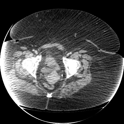 File:Collection due to leak after sleeve gastrectomy (Radiopaedia 55504-61972 A 76).jpg