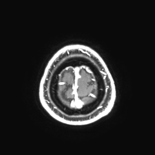 File:Colloid cyst (large) (Radiopaedia 34415-35729 Axial T1 C+ 31).png