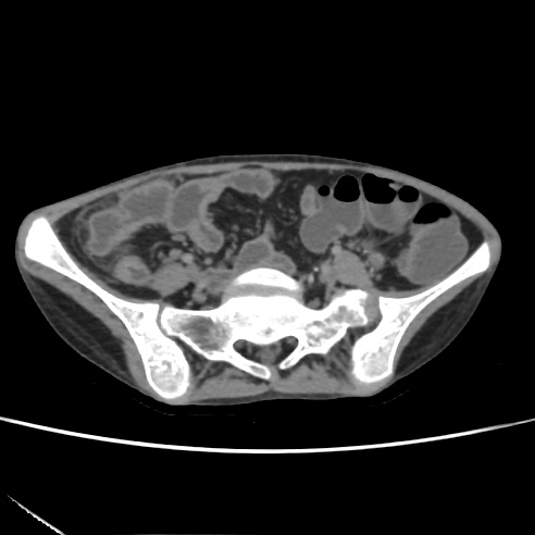 File:Colocolic fistula - Crohn disease (Radiopaedia 57063-63955 A 61).jpg