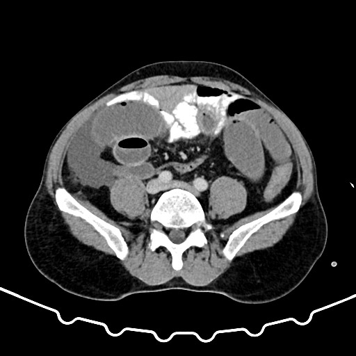 Colocolic intussusception due to large lipoma (Radiopaedia 68773-78482 A 127).jpg