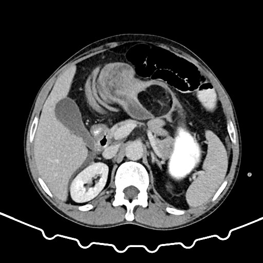 Colocolic intussusception due to large lipoma (Radiopaedia 68773-78482 A 52).jpg