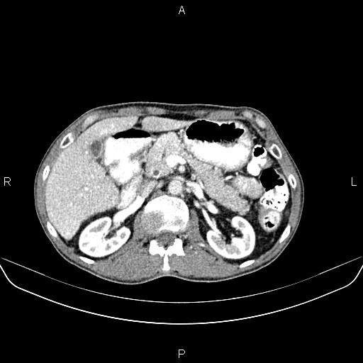 Colon adenocarcinoma - hepatic flexure (Radiopaedia 85635-101395 A 30).jpg