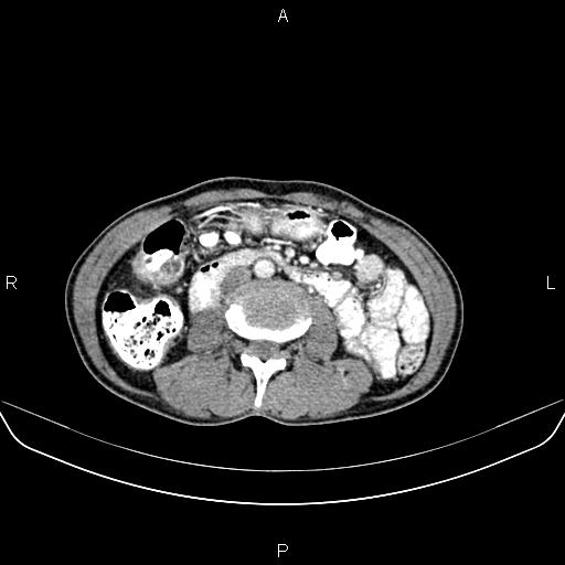 Colon adenocarcinoma - hepatic flexure (Radiopaedia 85635-101395 A 46).jpg