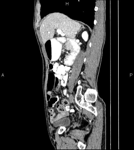 File:Colon adenocarcinoma - hepatic flexure (Radiopaedia 85635-101395 D 31).jpg