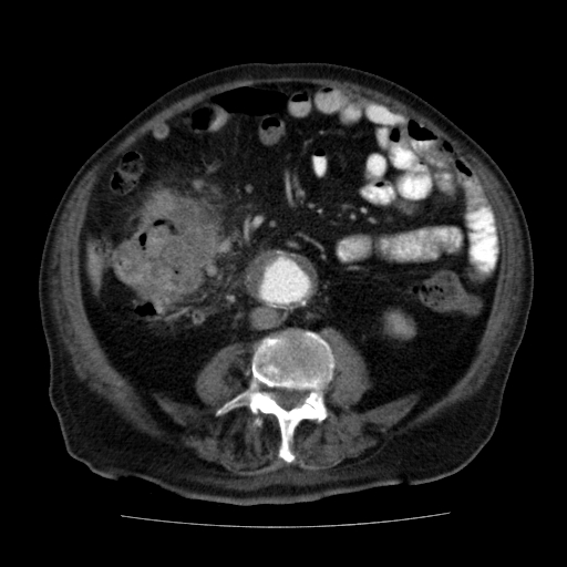File:Colon cancer with duodenal invasion (Radiopaedia 16278-15958 A 34).jpg