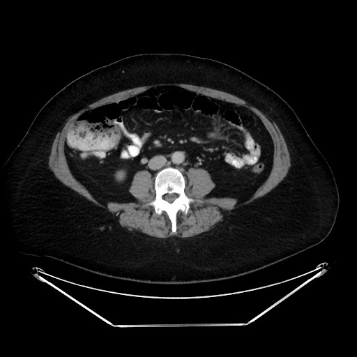 File:Colonic intussusception due to adenocarcinoma (Radiopaedia 86828-102987 A 84).jpg