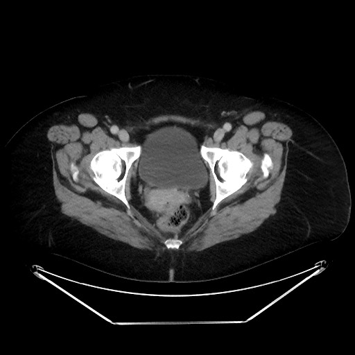 File:Colonic intussusception due to adenocarcinoma (Radiopaedia 86828-102987 Axial 108).jpg