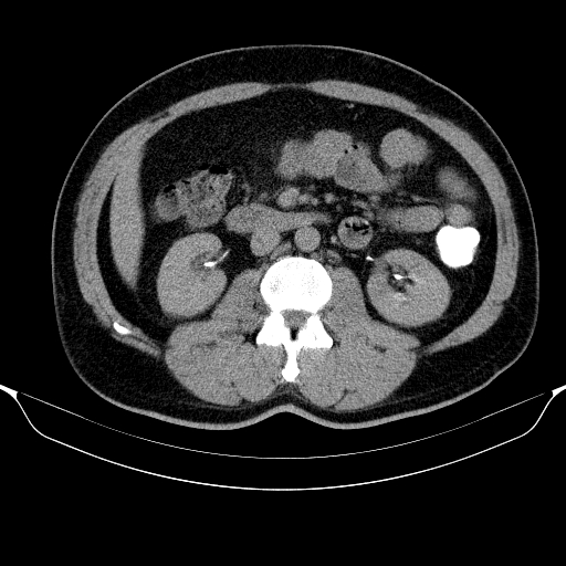 Colonic lipoma with colo-colic intussusception (Radiopaedia 58944-66200 Axial C+ rectal 28).jpg