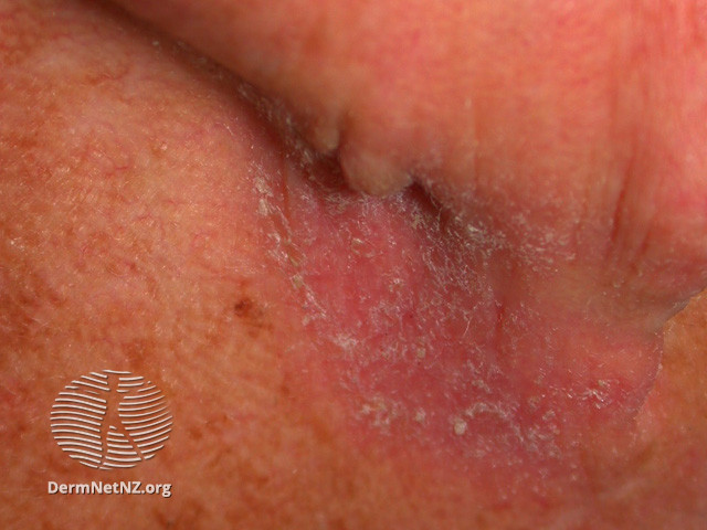 Intraepidermal carcinoma (DermNet NZ lesions-scc-in-situ-2943).jpg