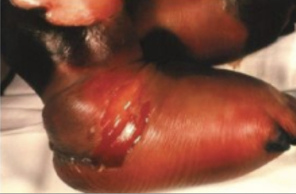 File:Meningococcal septicemia3.png