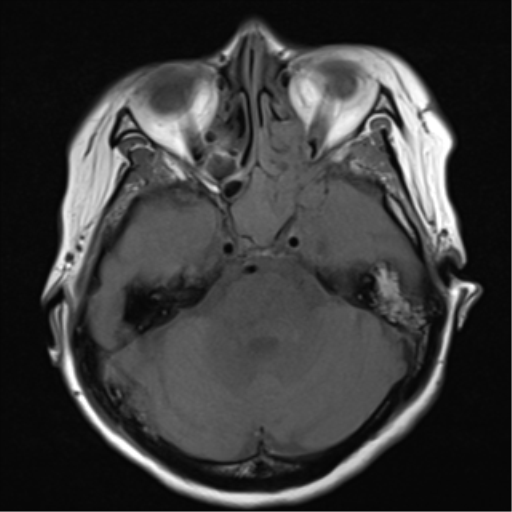 File:Nasopharyngeal carcinoma with cerebral abscess (Radiopaedia 43018-46273 Axial T1 13).png