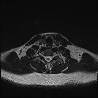 File:Nasopharyngeal carcinoma with perineural spread (Radiopaedia 55030-61380 Axial T2 73).jpg