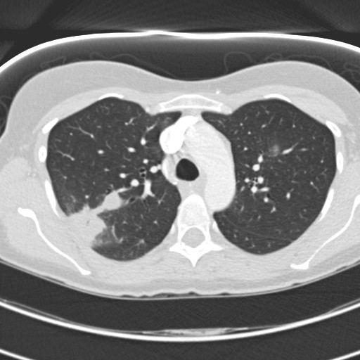 Necrobiotic pulmonary nodules - Crohn disease (Radiopaedia 20723-20631 Axial lung window 45).jpg