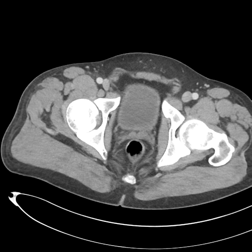 File:Necrotizing pancreatitis with acute necrotic collections (Radiopaedia 38829-41012 B 82).png