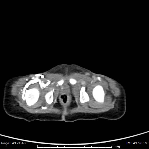 File:Neuroblastoma (Radiopaedia 41472-44355 A 43).jpg