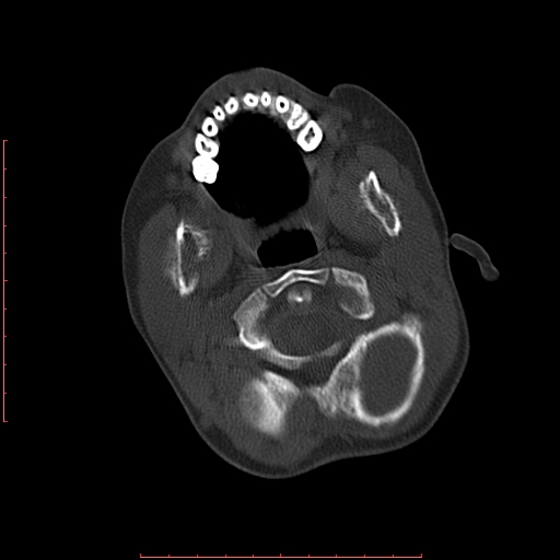 File:Neuroblastoma skull metastasis (Radiopaedia 56053-62683 Axial bone window 3).jpg