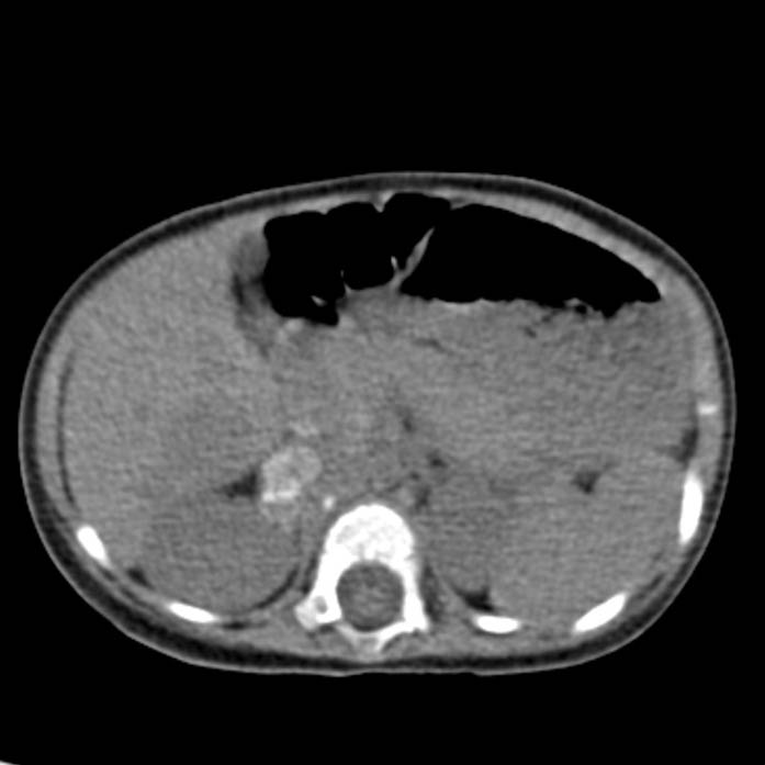 Neuroblastoma with skull metastases (Radiopaedia 30326-30960 Axial non-contrast 21).jpg