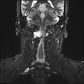 File:Neurofibromatosis type 1 (Radiopaedia 80355-93740 Coronal STIR 8).jpg