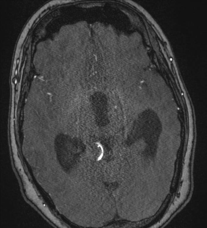 Neurofibromatosis type 1 - head and neck - CNS manifestations (Radiopaedia 49910-55188 Axial MRA 41).png