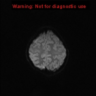 File:Neurofibromatosis type 1 with optic nerve glioma (Radiopaedia 16288-15965 Axial DWI 28).jpg