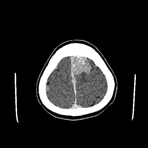 File:Neurofibromatosis type 2 (Radiopaedia 25389-25637 Axial C+ 89).jpg