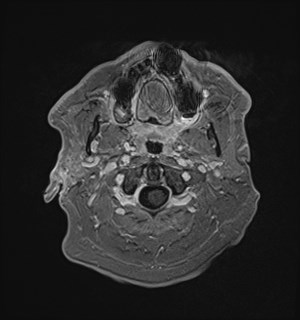 Neurofibromatosis type 2 (Radiopaedia 79097-92049 Axial T1 C+ 19).jpg