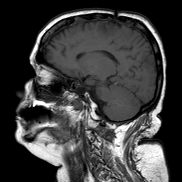 File:Neurofibromatosis type 2 (Radiopaedia 8713-9518 Sagittal T1 8).jpg