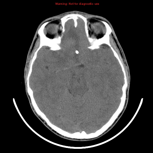 File:Neurofibromatosis type 2 (Radiopaedia 8953-9732 Axial non-contrast 14).jpg