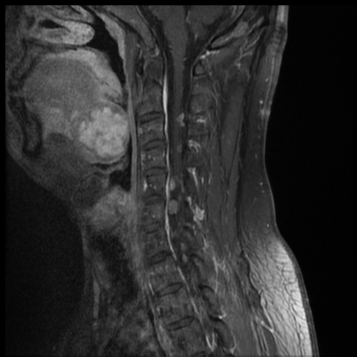 File:Neurofibromatosis type 2 (spinal manifestations) (Radiopaedia 53943-60070 G 5).png