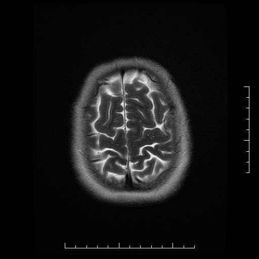 File:Neuroglial cyst of brainstem (Radiopaedia 29134-29526 Axial T2 19).jpg
