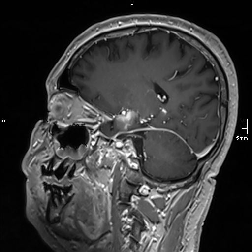 Neurosarcoidosis - involvement of the mesial temporal lobes (Radiopaedia 67429-76820 Sagittal T1 C+ 105).jpg