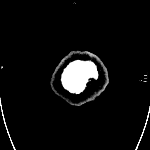 File:Neurotoxoplasmosis - concentric target sign (Radiopaedia 70644-80783 Axial non-contrast 45).jpg