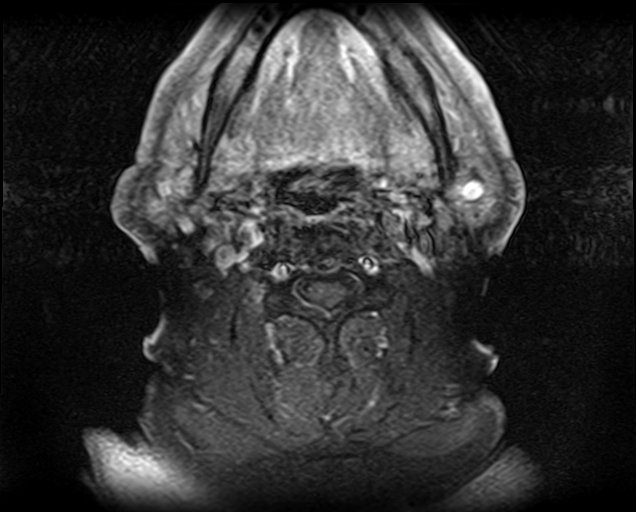 File:Non-Hodgkin lymphoma - parotid gland (Radiopaedia 71531-81890 Axial T1 C+ fat sat 8).jpg