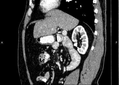 Non-syndromic pancreatic endocrine tumor (Radiopaedia 86958-103178 E 39).jpg