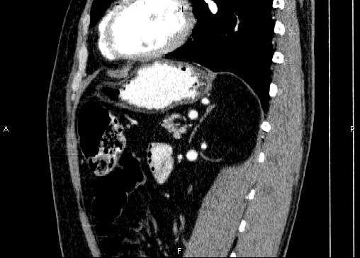 Non-syndromic pancreatic endocrine tumor (Radiopaedia 86958-103178 E 68).jpg