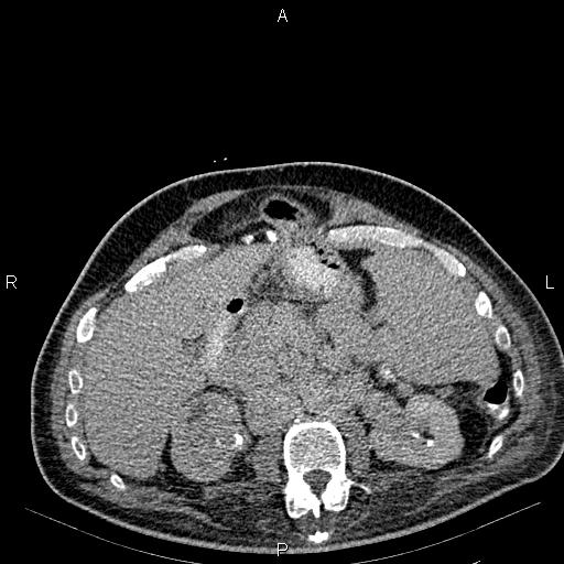 Non Hodgkin lymphoma in a patient with ankylosing spondylitis (Radiopaedia 84323-99621 Axial C+ delayed 26).jpg