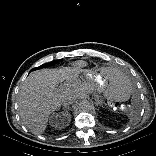 File:Non Hodgkin lymphoma in a patient with ankylosing spondylitis (Radiopaedia 84323-99621 Axial non-contrast 28).jpg