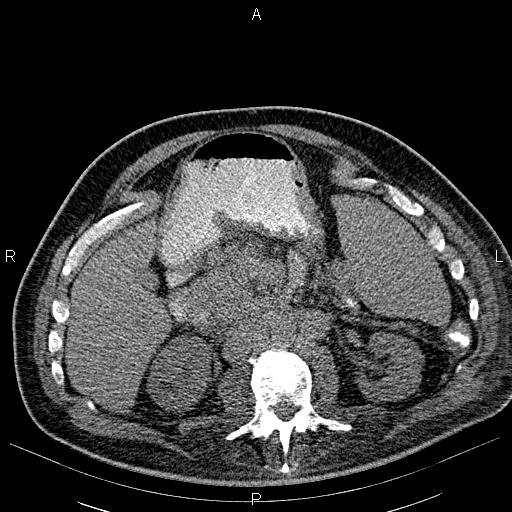 File:Non Hodgkin lymphoma in a patient with ankylosing spondylitis (Radiopaedia 84323-99621 Axial non-contrast 35).jpg