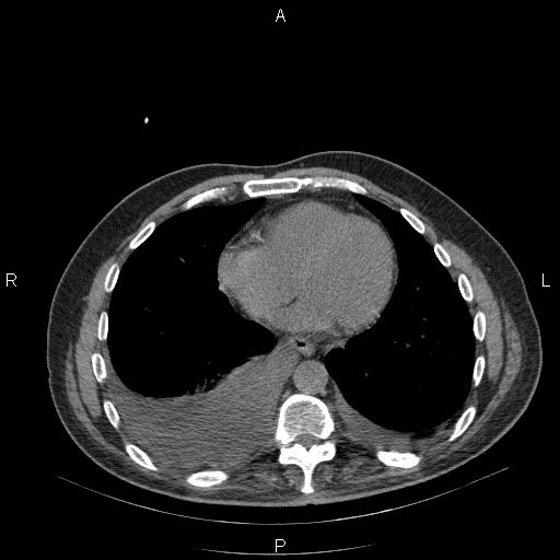 File:Non Hodgkin lymphoma in a patient with ankylosing spondylitis (Radiopaedia 84323-99624 Axial non-contrast 24).jpg