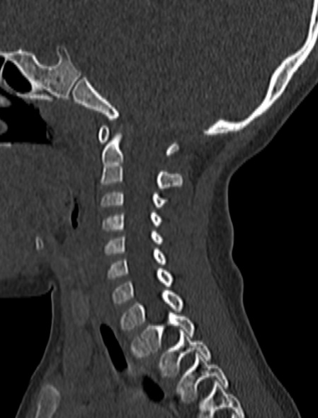 File:Normal CT cervical spine - pediatric (Radiopaedia 52549-58462 Sagittal bone window 129).jpg