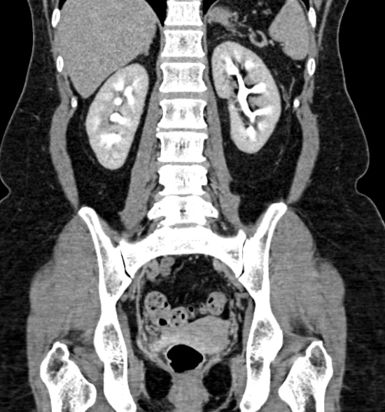 Normal CT intravenous urogram (Radiopaedia 39444-41759 A 311).jpg