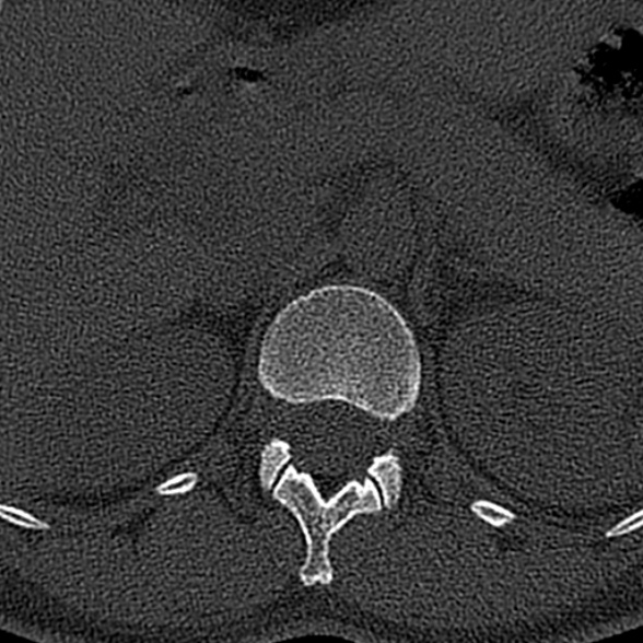 File:Normal CT lumbar spine (Radiopaedia 53981-60118 Axial bone window 8).jpg