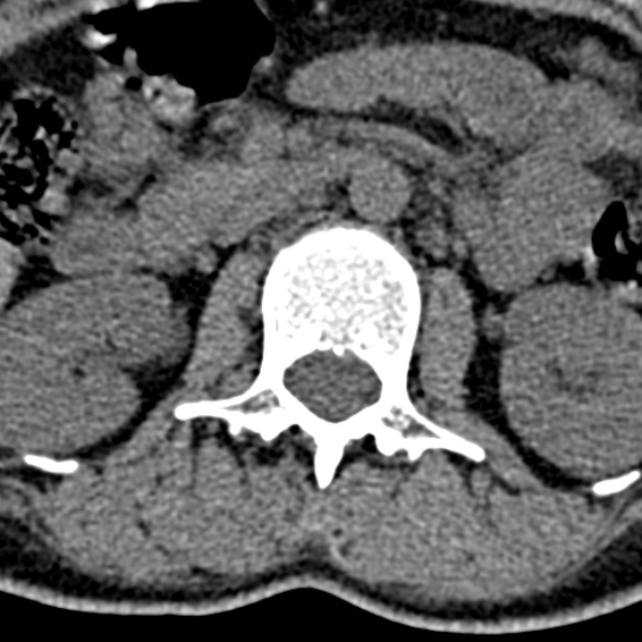 Normal CT lumbar spine (Radiopaedia 53981-60118 Axial non-contrast 33).jpg