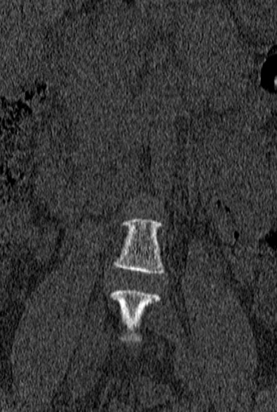 Normal CT lumbar spine (Radiopaedia 53981-60118 Coronal bone window 3).jpg